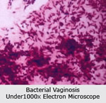 bacterial vahinosis bv
